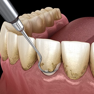 Illustration of scaling the teeth