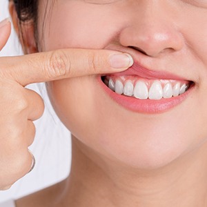 Woman showing off her gums and teeth